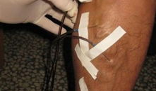 静脉曲张放血视频,直观视频解析